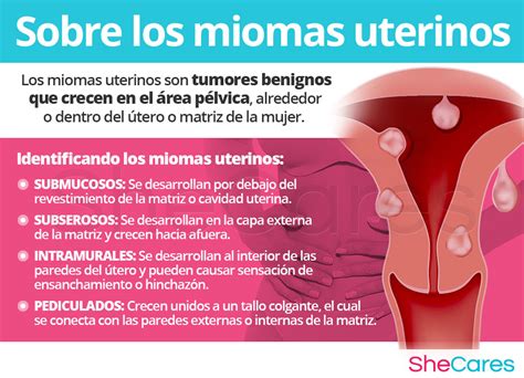 psicología Criatura Móvil señales de miomas uterinos Barriga Intercambiar Sada