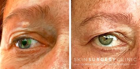 Xanthelasma Removal Leeds Bradford Before And After Photos 2023 1