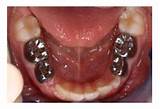 Images of Silver Crowns Teeth Cost