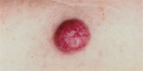 Factors that may increase your risk of merkel cell carcinoma include: Merkel Cell Carcinoma - Cancer Effects