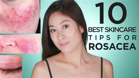 10 Best Skin Care Tips For Rosacea Vivienne Fung Rosacea คือเนื้อหา