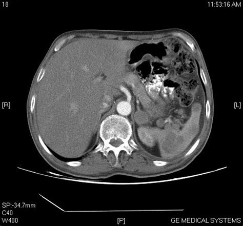 Ct Scan Abdomen Showing Enlarged Lymph Nodes And Splenic Lesions