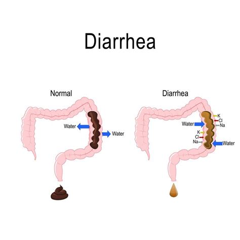 Possible causes, signs and symptoms, standard treatment options and means of care and support. Diarrhea Guide: Causes, Symptoms and Treatment Options