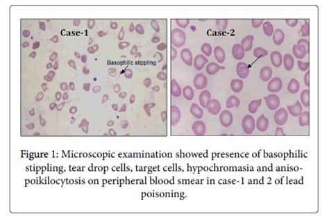 Target Cells Blood Film Causes Галерија слика