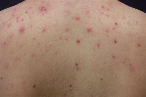 Acne On The Back 5 Reasons For Their Occurrence And How