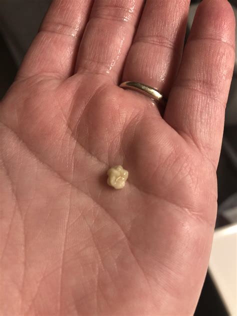 Tonsil Stone Fresh Out The Back Of A Throat Popping