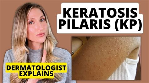 Dermatologist Explains Keratosis Pilaris Kp Affordable Drugstore