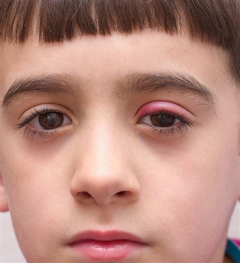 Stye Treatment Kids