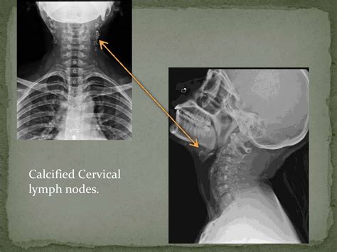 Tuberculosis Oral Pathology