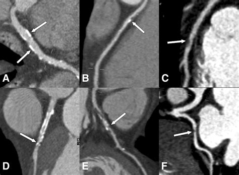 Coronary Atherosclerosis In African American And White Patients With