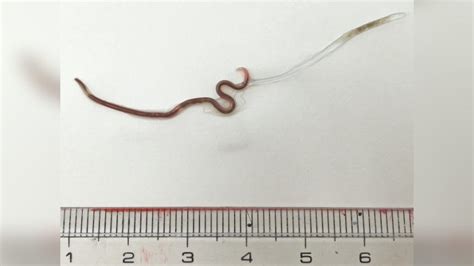 Doctors Remove Live Worm From Womans Tonsil East Idaho News