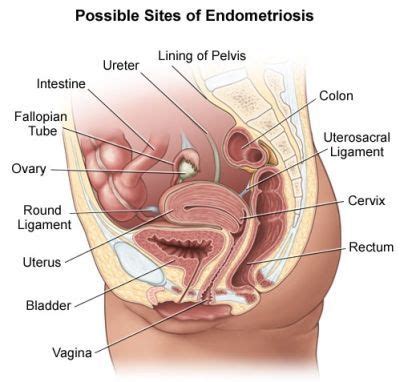An early diagnosis, a multidisciplinary the main complication of endometriosis is impaired fertility. A Better Understanding of Endometriosis - Doctor Tipster