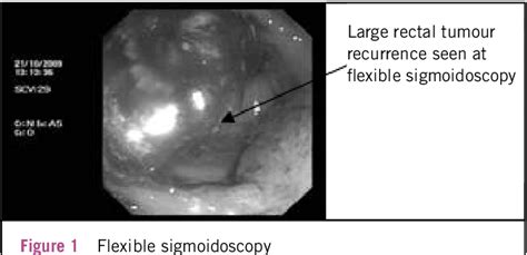 Figure 1 From Transrectal High Intensity Focused Ultrasonography Is