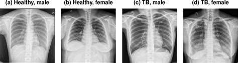 Chest X Ray Tb Vs Normal