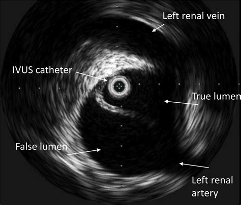 The Use Of Intravascular Ultrasound In The Treatment Of Type B Aortic