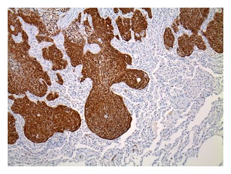Metastatic Squamous Cell Carcinoma Of The Anus To The Lung Confirmed