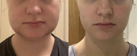 Day 4 To Day 9 Still Some Asymmetry In The Lips But The Bulk Of The
