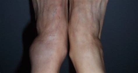 What Are The Treatments For A Blocked Vein Causing Swelling In The Ankle