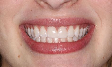2 Front Teeth Crowns Before And After Photos Midland Park Nj