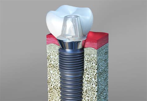 Osseointegration Dental Implants In Apex And Cary Nc