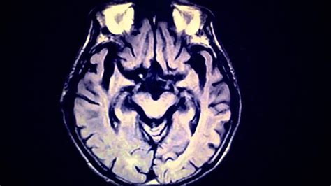 Mri Brain In Alzheimers Disease Youtube