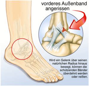 Fuß und Sprunggelenkserkrankungen Orthopädische Praxis Fritzlar
