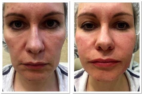 Before And After Of Thermage 3 Facelift Info Prices Photos