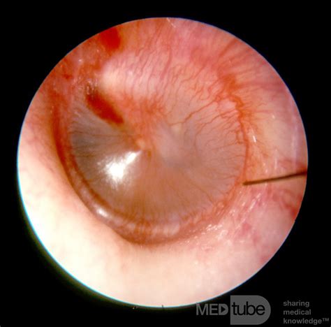 Early Acute Otitis Media Stage Of Redness Picture