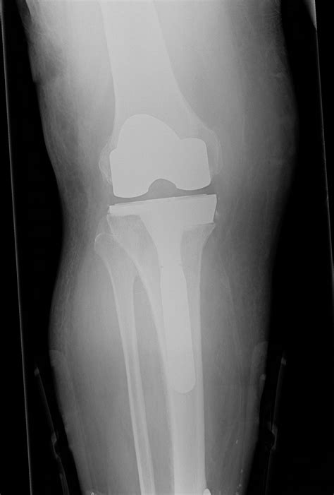 Revision Knee Replacement Knee Hip And Shoulder