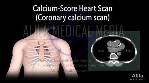Alila Medical Media Calcium Score Test For Risk Of Heart Attack