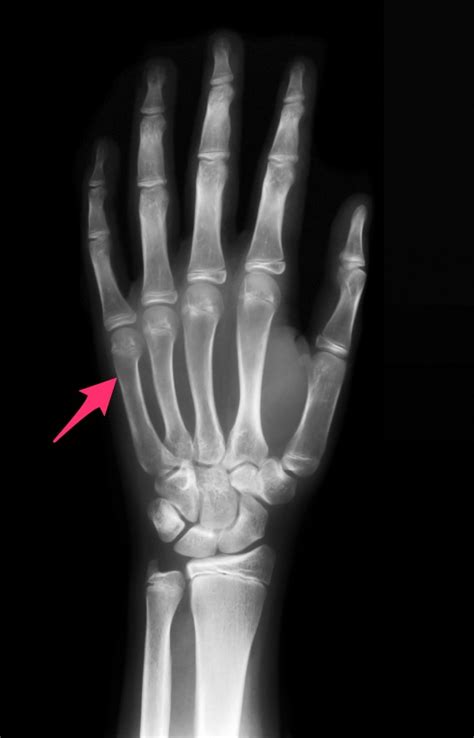 Boxers Fracture Diagnosis Treatment And Recovery From This Difficult