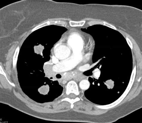 Metastatic Renal Cell Carcinoma To Lung Mediastinum And Spleen Chest