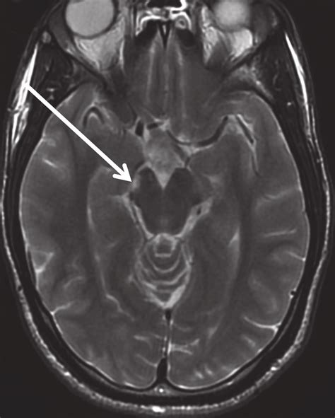 Axial Brain Mri Performed At Different Times In Case 3 Flair Sequence