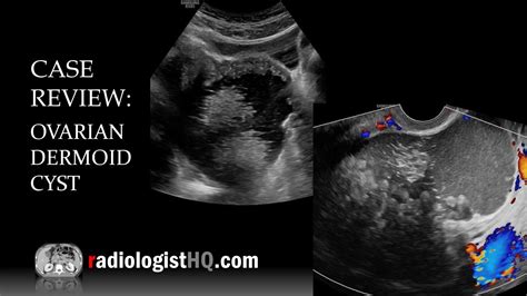 Case Review Ultrasound Of Ovarian Dermoid Cyst Youtube
