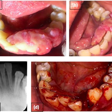 Pdf Large Peripheral Ossifying Fibroma Interfering With The Normal