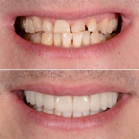 Worn Teeth Are Often The Result Of An Imperfect Bite Here The Smile Has Been Restored With