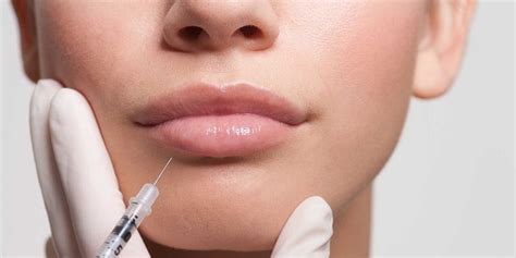 Radiesse Vs Juvederm For Lips What Is The Difference Maylips