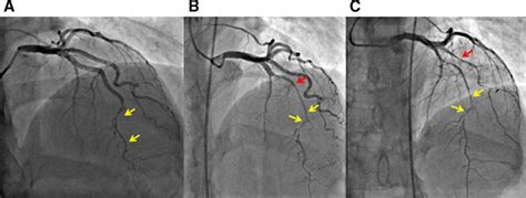 Spontaneous Coronary Artery Dissection Circulation Cardiovascular