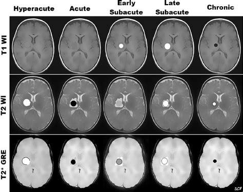 Intracranial Hemorrhage Made Easy A Semiological Approach On Ct And