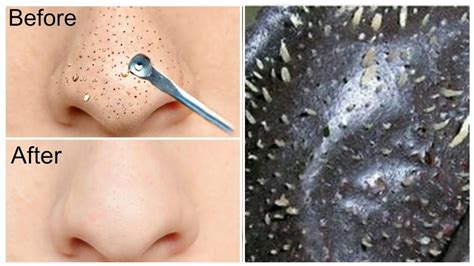 easy diy blackhead remover peel off mask removes everything youtube
