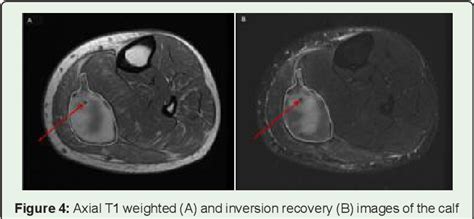 Figure 5 From Mri Evaluation Of Calf Hematoma Frequency Of Plantaris