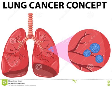 Lung Cancer Clip Art 10 Free Cliparts Download Images On Clipground 2023