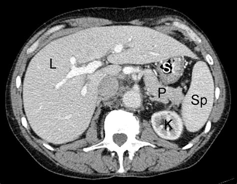 Example Of Normal Contrast Enhanced Abdominal Ct Scan In Human