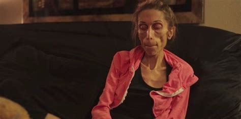 A 40 Pound Woman With Anorexia Has Released A Heartbreaking Video