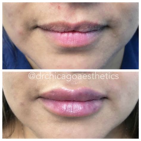 Lip Filler Injections Chicago Medspa And Aesthetics Lip Fillers