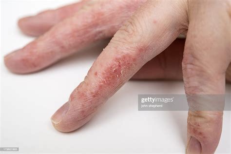 Dry Cracked Skin Condition Eczema High Res Stock Photo Getty Images