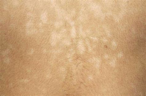 Pityriasis versicolor Dermatose à traiter soigneusement