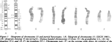 Figure 1 From Case Angelman Syndrome With A Chromosomal Inversion 15 Inv Pl 1 Q 1 3 Accompanied