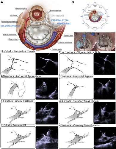 Novel Intra Annular Mitral Valve Imaging With Intracardiac