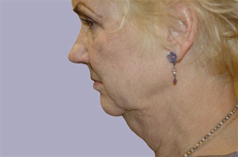Before A Facelift In Tampa Facial Plastic Surgery